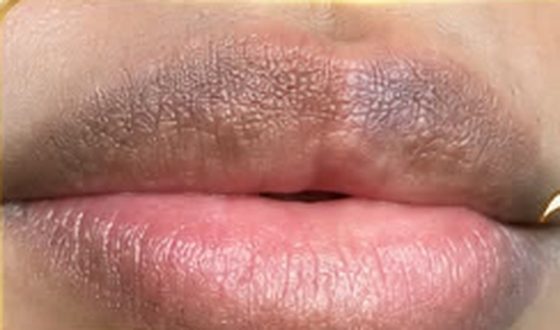 Before: lips with an uneven, darker tone
